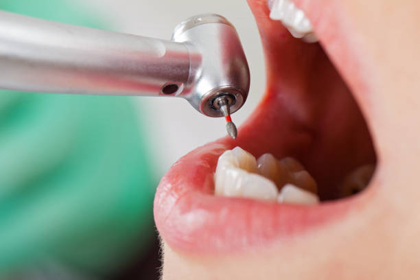 Best Emergency Treatment for Dental Infections or Abscesses in Compo, CT